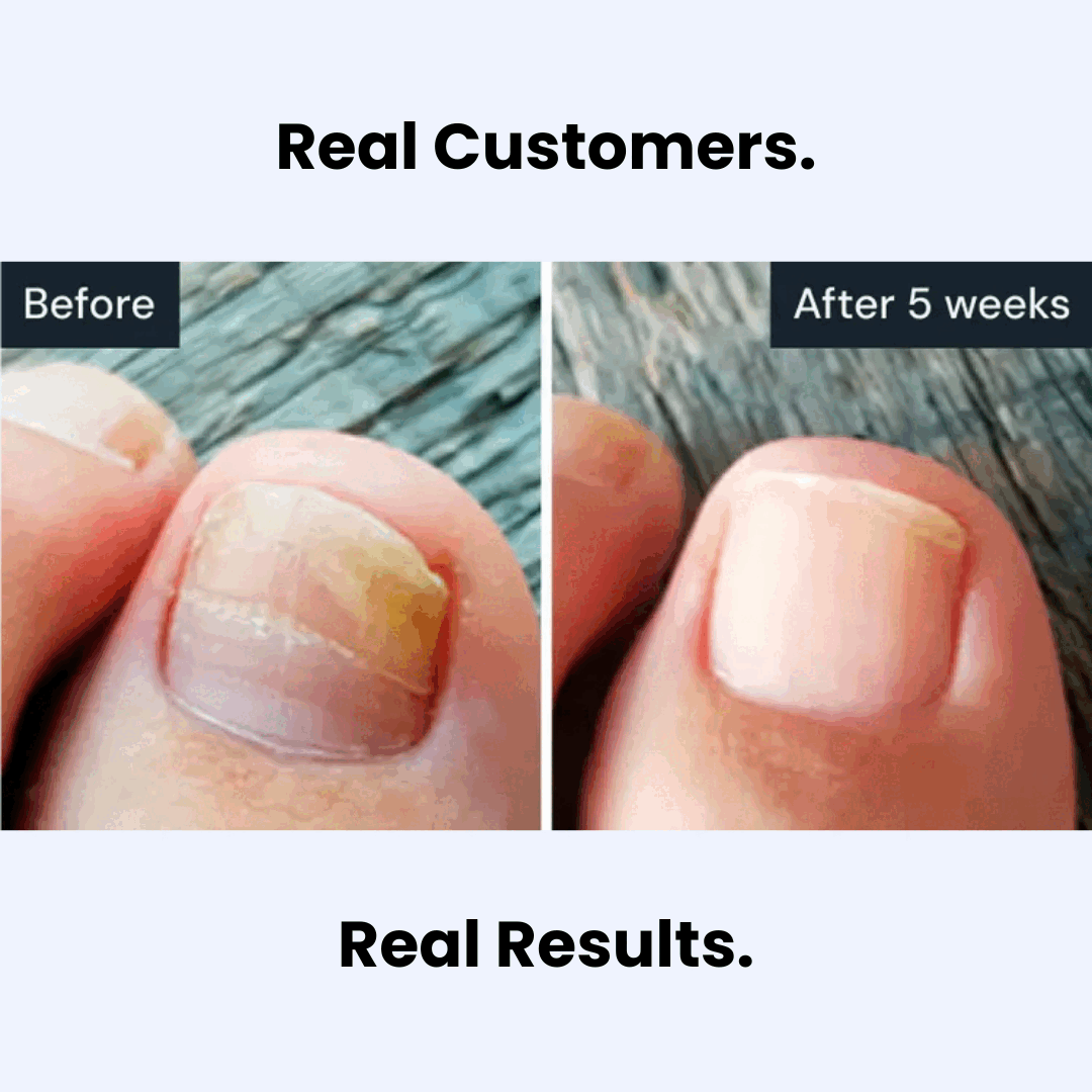 Antifungal treatment pen product image 2